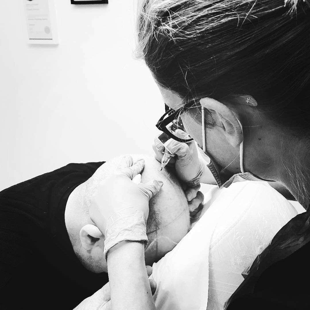 Charlotte Drinkwater performing scalp micropigmentation at Simply Scalp