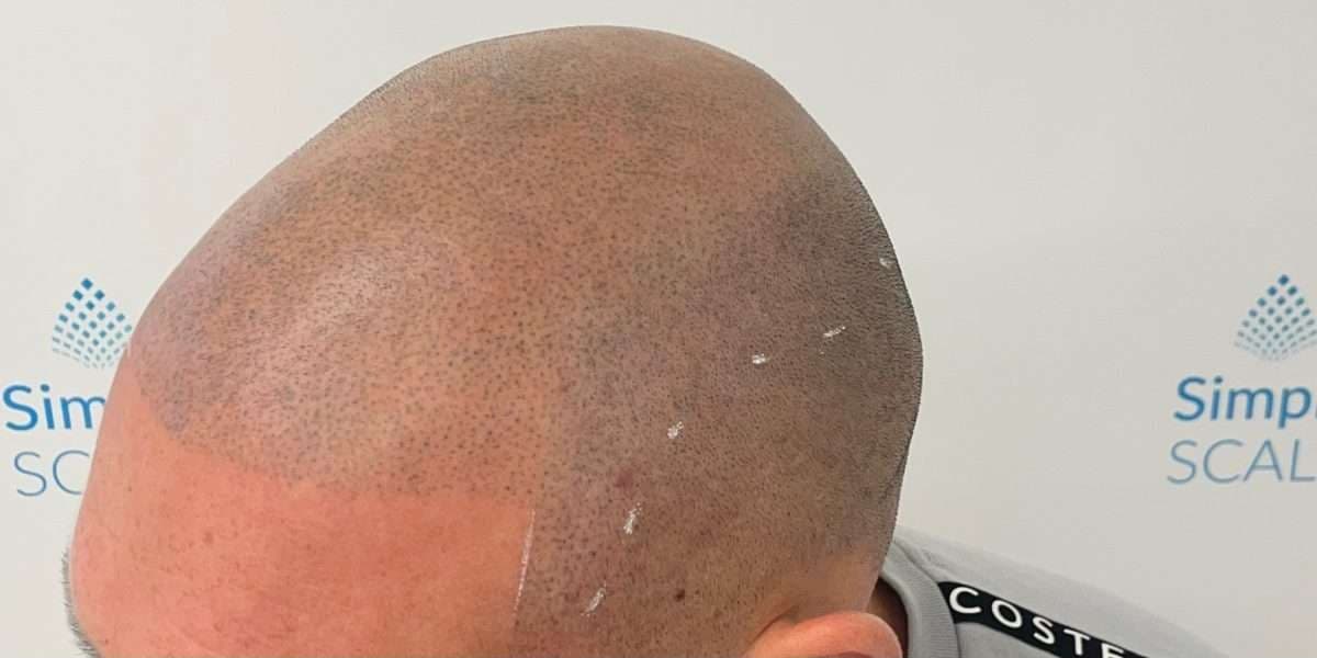 Client scalp after scalp micropigmentation session