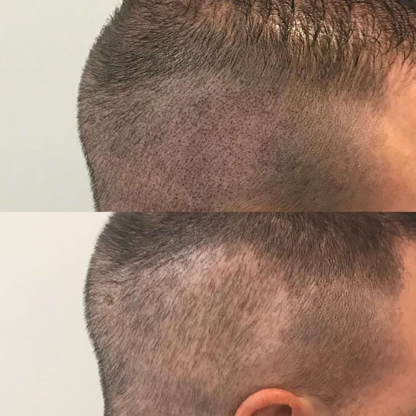 Hairline — Simply Scalp client work